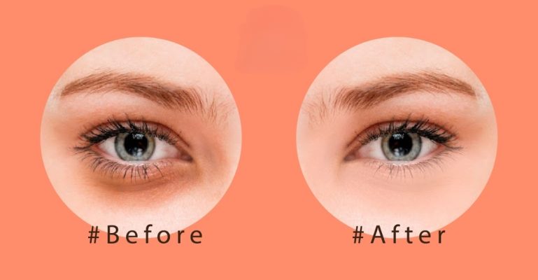 Cách xóa bọng mắt bằng Photoshop bằng Healing Brush